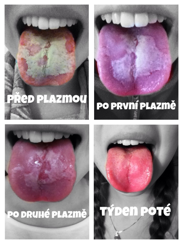 Jazyk po plasmování